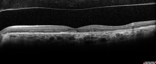 Geographic Atrophy with recent vision loss left eye
80 year old Recent vision loss in the left eye for about 6 weeks. 
Hyperlipidemia, HTN, Angina, history of TIAâ€™s
ASA daily
VA 20/25 OD, 20/63 OS (was 20/40 5/3/21 at patients first visit)
AC pseudophakic
