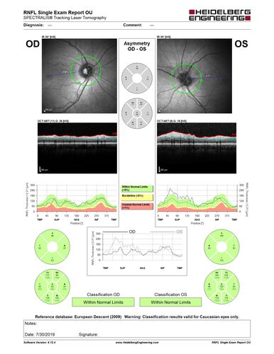 Arteritic Anterior Ischmic Optic Neuropathy Left Eye
78 year old female with 5 day history of decreased vision in the left eye (sudden onset)  She has been treated for GCA but her steroids were tapered down to 20 mg daily and she is not feeling well since the taper:
VA 20/20 OD, 20/25 OS ( APD OS)
