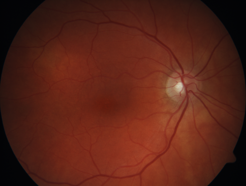 Giant Cell Arteritis - Anterior Ischemic Optic Neuropathy - Left Eye
78 year old female with vision loss on steroid taper for GCA.  Superior pole of optic nerve left eye is swollen
