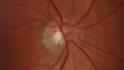 Giant Cell Arteritis - Anterior Ischemic Optic Neuropathy - Left Eye
78 year old female with vision loss on steroid taper for GCA.  Superior pole of optic nerve left eye is swollen
