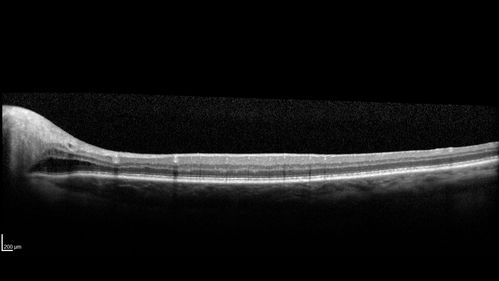 Giant Cell Arteritis - Anterior Ischemic Optic Neuropathy - Left Eye
78 year old female with vision loss on steroid taper for GCA.  Superior pole of optic nerve left eye is swollen
