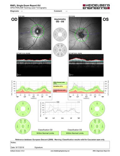 Giant Cell Arteritis - Anterior Ischemic Optic Neuropathy - Left Eye
78 year old female with vision loss on steroid taper for GCA.  Superior pole of optic nerve left eye is swollen
