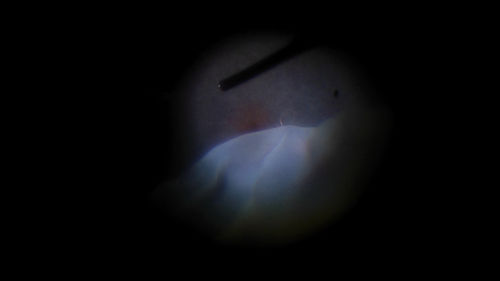 Giant Retinal Tear Retinal Detachment
13 year old african american girl high myope.  These intra-operative photos show parts of the procedure for this giant tear detachment.  The video is on youtube.  You can see the center of the macula with no overlying retina.
