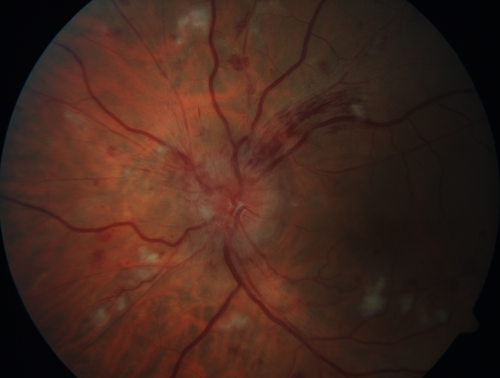 Grade 4 hypertensive retinopathy
55 year old man Hhe did have headaches a few weeks ago and also some nausea and vomiting.  He noticed for a few weeks the vision in the left eye was blurred and  that the vision in the left eye is dark.  
VA OD: Dcc20/20 
VA OS: Dcc20/100-1

He was admitted directly to ICU for blood pressure control (290 / 170 mmHg)
3 weeks later his VA increased to 20/20 OD, 20/32 OS
