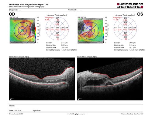 Grade 4 hypertensive retinopathy
55 year old man Hhe did have headaches a few weeks ago and also some nausea and vomiting.  He noticed for a few weeks the vision in the left eye was blurred and  that the vision in the left eye is dark.  
VA OD: Dcc20/20 
VA OS: Dcc20/100-1

He was admitted directly to ICU for blood pressure control (290 / 170 mmHg)
3 weeks later his VA increased to 20/20 OD, 20/32 OS
