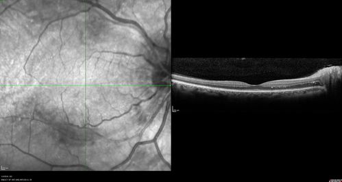 Grade 4 hypertensive retinopathy
55 year old man Hhe did have headaches a few weeks ago and also some nausea and vomiting.  He noticed for a few weeks the vision in the left eye was blurred and  that the vision in the left eye is dark.  
VA OD: Dcc20/20 
VA OS: Dcc20/100-1

He was admitted directly to ICU for blood pressure control (290 / 170 mmHg)
3 weeks later his VA increased to 20/20 OD, 20/32 OS

