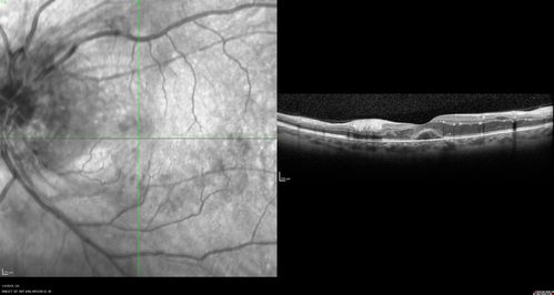 Grade 4 hypertensive retinopathy
55 year old man Hhe did have headaches a few weeks ago and also some nausea and vomiting.  He noticed for a few weeks the vision in the left eye was blurred and  that the vision in the left eye is dark.  
VA OD: Dcc20/20 
VA OS: Dcc20/100-1

He was admitted directly to ICU for blood pressure control (290 / 170 mmHg)
3 weeks later his VA increased to 20/20 OD, 20/32 OS
