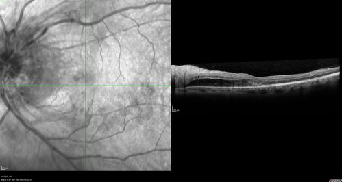 Grade 4 hypertensive retinopathy
55 year old man Hhe did have headaches a few weeks ago and also some nausea and vomiting.  He noticed for a few weeks the vision in the left eye was blurred and  that the vision in the left eye is dark.  
VA OD: Dcc20/20 
VA OS: Dcc20/100-1

He was admitted directly to ICU for blood pressure control (290 / 170 mmHg)
3 weeks later his VA increased to 20/20 OD, 20/32 OS
