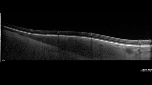 Choroidal Nevus with Halo

