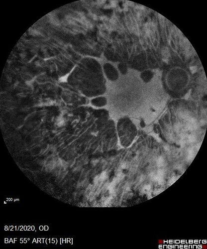 Pan Retinal Laser from original DRS study in the 1970s - 50 years later
67 year old female with diabetes since age 8.  She had heavy PRP laser to both eyes in the 1970s by Lloyd M. Aiello, M.D, the father of PRP laser.  Her vision is poor now, 1/200 OD and 20/200 OS.
