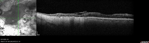 Pan Retinal Laser from original DRS study in the 1970s - 50 years later
67 year old female with diabetes since age 8.  She had heavy PRP laser to both eyes in the 1970s by Lloyd M. Aiello, M.D, the father of PRP laser.  Her vision is poor now, 1/200 OD and 20/200 OS.
