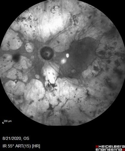Pan Retinal Laser from original DRS study in the 1970s - 50 years later
67 year old female with diabetes since age 8.  She had heavy PRP laser to both eyes in the 1970s by Lloyd M. Aiello, M.D, the father of PRP laser.  Her vision is poor now, 1/200 OD and 20/200 OS.
