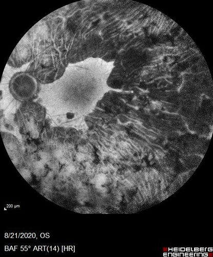 Pan Retinal Laser from original DRS study in the 1970s - 50 years later
67 year old female with diabetes since age 8.  She had heavy PRP laser to both eyes in the 1970s by Lloyd M. Aiello, M.D, the father of PRP laser.  Her vision is poor now, 1/200 OD and 20/200 OS.
