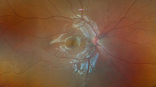 Choroidal hemangioma 10 year old black male
10 year old black child The patient has been wearing glasses which for 3 years and the left eye has had a changing prescription. 
3/13/23: OD: +1.00; OS: +5.50
7/18/24: OD: +1.00; OS: +8.00 -1.25 x 015
2/3/25: (Cycloplegic): OD: +2.00; OS: 11.50+1.50 x 120
She had an MRI scan was not diagnostic.

VA OD:20/16 
 OS: 20/30-2
B-scan 5.1 mm H x 12.3 mm A x 15.0 mm T highly reflective mass centered just temporal to the macula involving the entire macula).
Seen at Wills and observation was decided because of no macular fluid

