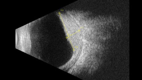 Choroidal hemangioma 10 year old black male
10 year old black child The patient has been wearing glasses which for 3 years and the left eye has had a changing prescription. 
3/13/23: OD: +1.00; OS: +5.50
7/18/24: OD: +1.00; OS: +8.00 -1.25 x 015
2/3/25: (Cycloplegic): OD: +2.00; OS: 11.50+1.50 x 120
She had an MRI scan was not diagnostic.

VA OD:20/16 
 OS: 20/30-2
B-scan 5.1 mm H x 12.3 mm A x 15.0 mm T highly reflective mass centered just temporal to the macula involving the entire macula).
Seen at Wills and observation was decided because of no macular fluid
