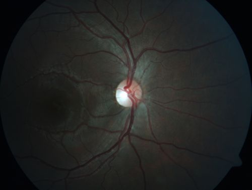Autosomal Dominant Optic Atrophy - Son
12 year old man.  His vision was not correctable to 20/20.  There was concern about possible macula problem.Â  His was diagnosed with Streff syndrome in NY.
VA OD: Dcc20/63 PH20/50-2 NccJ2
VA OS: Dcc20/63 PH20/50-2 NccJ3
IOP: TP: OD:10 OS:15 Time:02:24 PM
The diagnostic criteria for Streff syndrome are not well established, and the validity of this condition has not been recognized by The American Academy of Ophthalmology, The American Academy of Pediatric Ophthalmology, The American Academy of Optometry or The American academy of Pediatrics.
