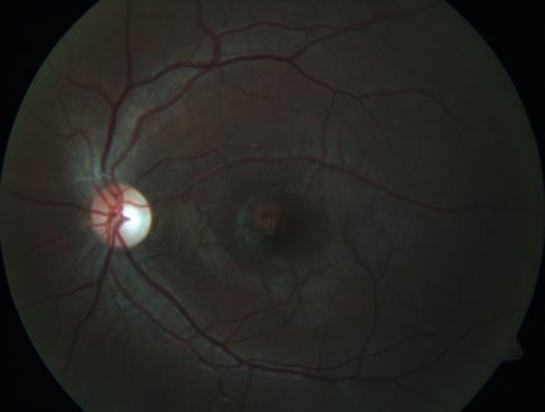 Autosomal Dominant Optic Atrophy - Son
12 year old man.  His vision was not correctable to 20/20.  There was concern about possible macula problem.Â  His was diagnosed with Streff syndrome in NY.
VA OD: Dcc20/63 PH20/50-2 NccJ2
VA OS: Dcc20/63 PH20/50-2 NccJ3
IOP: TP: OD:10 OS:15 Time:02:24 PM
The diagnostic criteria for Streff syndrome are not well established, and the validity of this condition has not been recognized by The American Academy of Ophthalmology, The American Academy of Pediatric Ophthalmology, The American Academy of Optometry or The American academy of Pediatrics.
