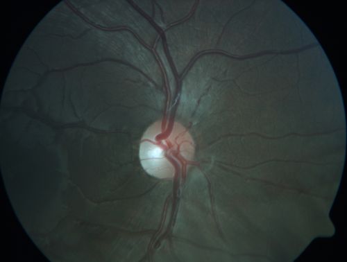 Autosomal Dominant Optic Atrophy - Son
12 year old man.  His vision was not correctable to 20/20.  There was concern about possible macula problem.Â  His was diagnosed with Streff syndrome in NY.
VA OD: Dcc20/63 PH20/50-2 NccJ2
VA OS: Dcc20/63 PH20/50-2 NccJ3
IOP: TP: OD:10 OS:15 Time:02:24 PM
The diagnostic criteria for Streff syndrome are not well established, and the validity of this condition has not been recognized by The American Academy of Ophthalmology, The American Academy of Pediatric Ophthalmology, The American Academy of Optometry or The American academy of Pediatrics.
