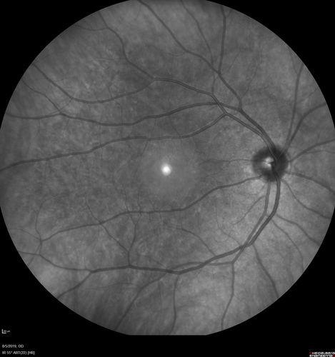 Heterochromia - Left Fundus - Possible Waardenburg Syndrome
49 year old female with normal vision.  No hearing loss. Fundus in the left eye has large patchy hypopigmentation.  OCT in that area shows decrease vascularity.
