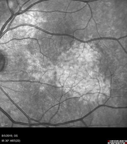 Heterochromia - Left Fundus - Possible Waardenburg Syndrome
49 year old female with normal vision.  No hearing loss. Fundus in the left eye has large patchy hypopigmentation.  OCT in that area shows decrease vascularity.
