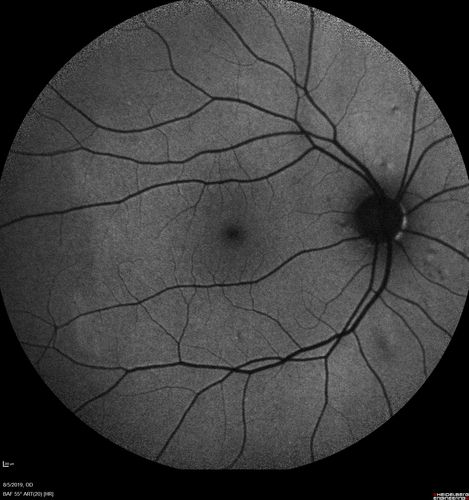 Heterochromia - Left Fundus - Possible Waardenburg Syndrome
49 year old female with normal vision.  No hearing loss. Fundus in the left eye has large patchy hypopigmentation.  OCT in that area shows decrease vascularity.
