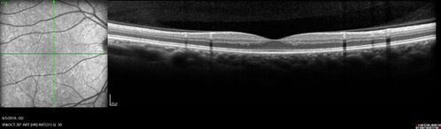 Heterochromia - Left Fundus - Possible Waardenburg Syndrome
49 year old female with normal vision.  No hearing loss. Fundus in the left eye has large patchy hypopigmentation.  OCT in that area shows decrease vascularity.
