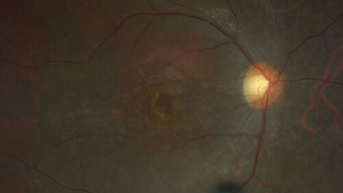 hydroxychloroquine (Plaquenil) Toxicity - Taiwanese - 3 years post stopping
59 year old female on 400 mg plaquenil for 22 years. 3 years ago, when stopping plaquenil, VA 20/50 both eyes.  Plaquenil was stopped.  The vision in the left eye continued to deteriorate to 3/200.  5'2" 127 lb (6.6 mg/kg body weight) -- Vision in these images is 20/80 OD, 5/200 OS - Vision loss now seems stable.
