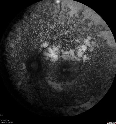 hydroxychloroquine (Plaquenil) Toxicity - Taiwanese - 3 years post stopping
59 year old female on 400 mg plaquenil for 22 years. 3 years ago, when stopping plaquenil, VA 20/50 both eyes.  Plaquenil was stopped.  The vision in the left eye continued to deteriorate to 3/200.  5'2" 127 lb (6.6 mg/kg body weight) -- Vision in these images is 20/80 OD, 5/200 OS - Vision loss now seems stable.
