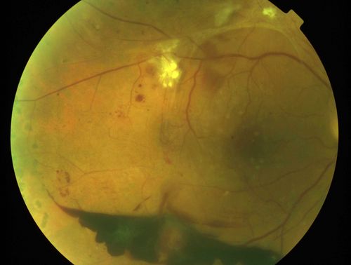 Macula Threatening Diabetic Traction Retinal Detachment - Proliferative Diabetic Retinopathy - Vitreous Hemorrhage
Vision 20/50 but tractional retinal detachment supero-temporally is extending toward fovea and vessels are still active on optic nerve.
