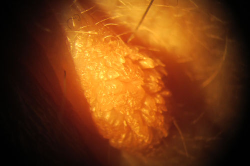 Lid Verruca Vulgaris
