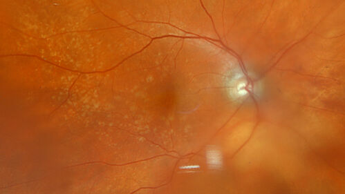 Idiopathic Polypoidal Choroidal Vasculopathy
83 year old man with wet AMD for 12 years resistant to Anti-VEGF therapy but responsive to PDT
