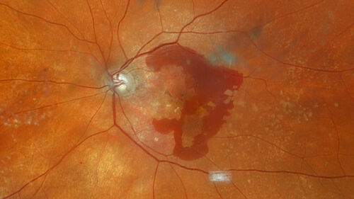 Idiopathic Polypoidal Choroidal Vasculopathy
83 year old man with wet AMD for 12 years resistant to Anti-VEGF therapy but responsive to PDT
