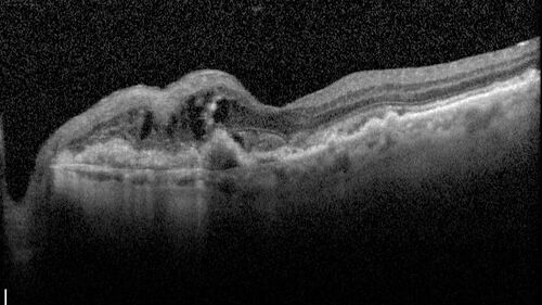 Idiopathic Polypoidal Choroidal Vasculopathy
83 year old man with wet AMD for 12 years resistant to Anti-VEGF therapy but responsive to PDT
