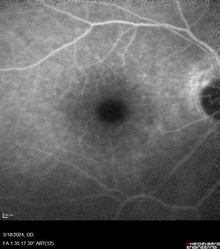 Idiopathic Polypoidal Choroidal Vasculopathy
83 year old man with wet AMD for 12 years resistant to Anti-VEGF therapy but responsive to PDT
