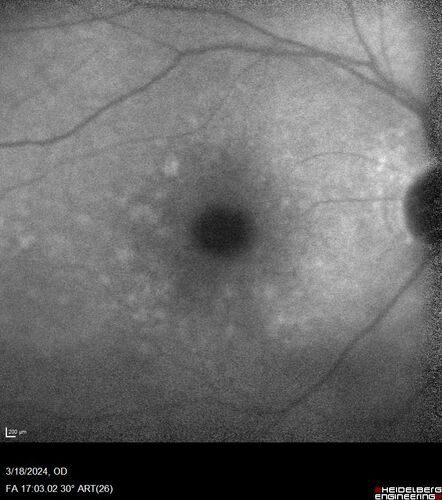 Idiopathic Polypoidal Choroidal Vasculopathy
83 year old man with wet AMD for 12 years resistant to Anti-VEGF therapy but responsive to PDT
