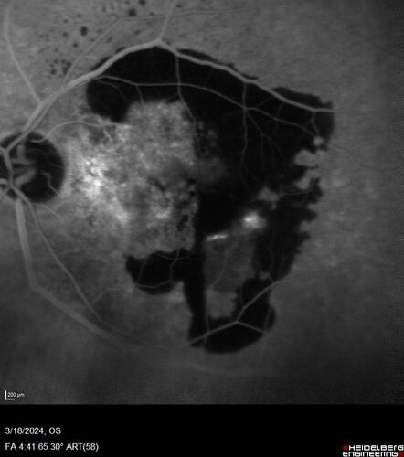Idiopathic Polypoidal Choroidal Vasculopathy
83 year old man with wet AMD for 12 years resistant to Anti-VEGF therapy but responsive to PDT
