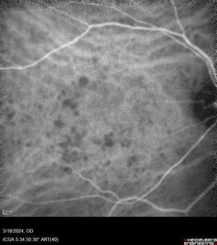 Idiopathic Polypoidal Choroidal Vasculopathy
83 year old man with wet AMD for 12 years resistant to Anti-VEGF therapy but responsive to PDT
