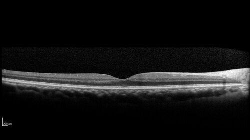 Occult Choroidal Neovascular Membrane
66 year old man with vision loss in the left eye for 2 months
VA 20/20 OD, 20/63 OS

