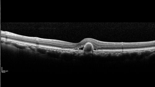Occult Choroidal Neovascular Membrane
66 year old man with vision loss in the left eye for 2 months
VA 20/20 OD, 20/63 OS
