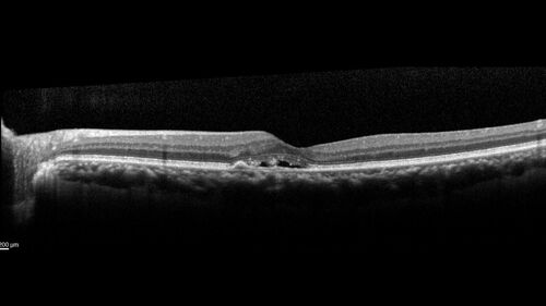Occult Choroidal Neovascular Membrane
66 year old man with vision loss in the left eye for 2 months
VA 20/20 OD, 20/63 OS
