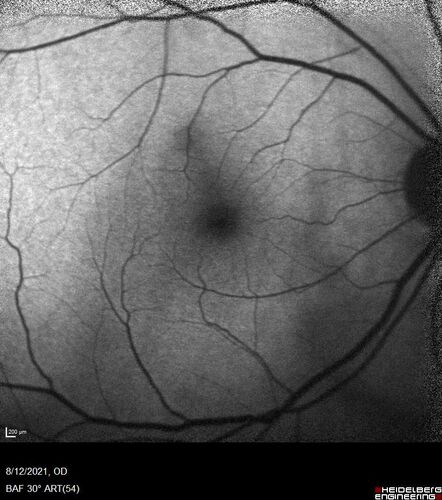 Occult Choroidal Neovascular Membrane
66 year old man with vision loss in the left eye for 2 months
VA 20/20 OD, 20/63 OS
