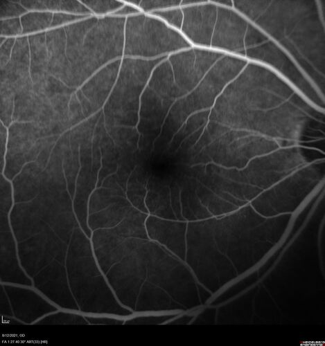 Occult Choroidal Neovascular Membrane
66 year old man with vision loss in the left eye for 2 months
VA 20/20 OD, 20/63 OS
