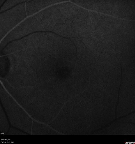 Occult Choroidal Neovascular Membrane
66 year old man with vision loss in the left eye for 2 months
VA 20/20 OD, 20/63 OS

