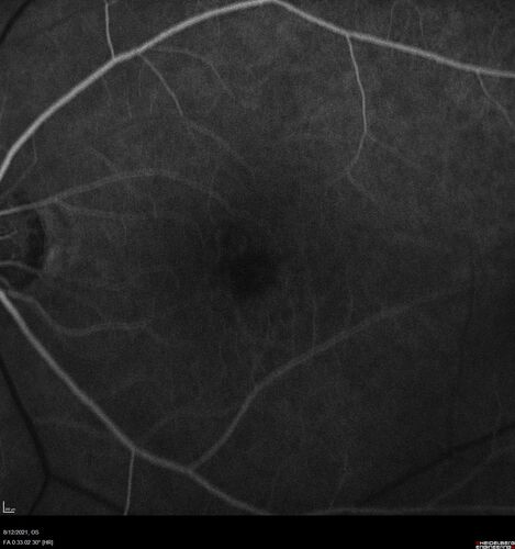 Occult Choroidal Neovascular Membrane
66 year old man with vision loss in the left eye for 2 months
VA 20/20 OD, 20/63 OS
