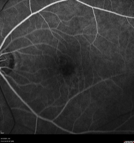 Occult Choroidal Neovascular Membrane
66 year old man with vision loss in the left eye for 2 months
VA 20/20 OD, 20/63 OS
