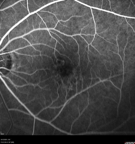 Occult Choroidal Neovascular Membrane
66 year old man with vision loss in the left eye for 2 months
VA 20/20 OD, 20/63 OS

