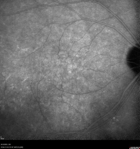 Occult Choroidal Neovascular Membrane
66 year old man with vision loss in the left eye for 2 months
VA 20/20 OD, 20/63 OS
