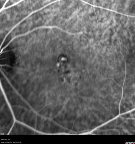 Occult Choroidal Neovascular Membrane
66 year old man with vision loss in the left eye for 2 months
VA 20/20 OD, 20/63 OS
