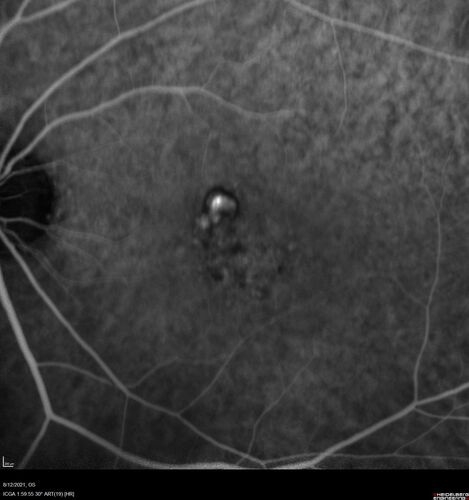 Occult Choroidal Neovascular Membrane
66 year old man with vision loss in the left eye for 2 months
VA 20/20 OD, 20/63 OS
