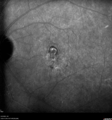 Occult Choroidal Neovascular Membrane
66 year old man with vision loss in the left eye for 2 months
VA 20/20 OD, 20/63 OS
